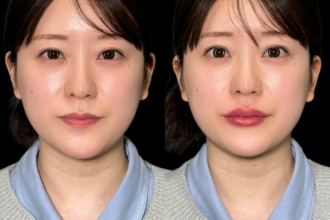 ヒアルロン酸注射(唇) ヒアルロン酸注射(唇)