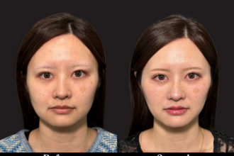 ジョールファット除去 ＋ 糸リフト＋ヒアルロン酸注射（顎）＋ボトックス注射（エラ）