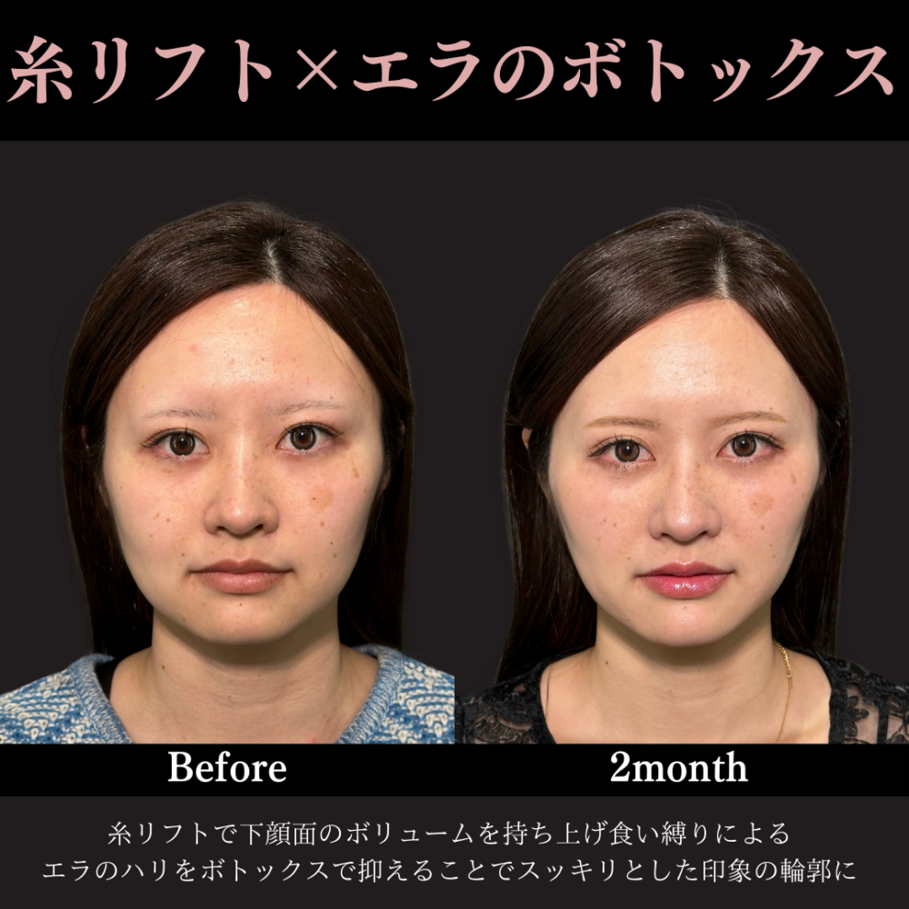 ジョールファット除去 ＋ 糸リフト＋ヒアルロン酸注射（顎）＋ボトックス注射（エラ）