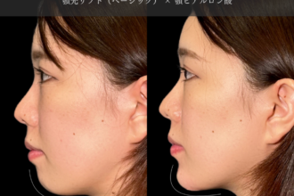 あご先リフト＋ ヒアルロン酸注射（顎）