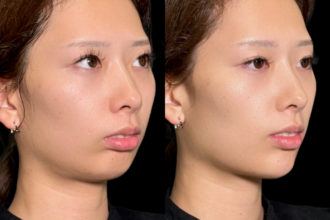 あご先リフト＋ ヒアルロン酸注射（顎）