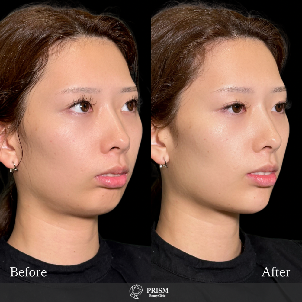 あご先リフト+ ヒアルロン酸注射(顎) あご先リフト+ ヒアルロン酸注射(顎)