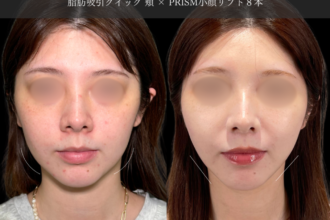 脂肪吸引クイック(頬・顎下)+糸リフト 脂肪吸引クイック(頬・顎下)+糸リフト