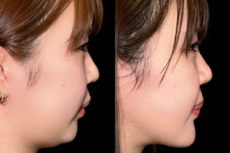 脂肪吸引プレミアム(頬・顎下)+ 糸リフト+メーラーファット除去+あご先リフト 脂肪吸引プレミアム(頬・顎下)+ 糸リフト+メーラーファット除去+あご先リフト