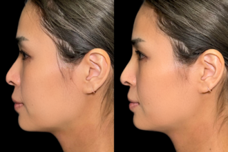 PRISMノーズスレッド