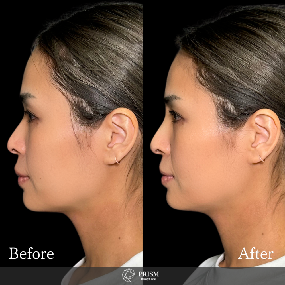 症例写真 < 新宿・町田の美容外科・美容皮膚科｜PRISM Beauty Clinic