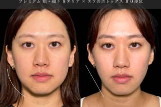 脂肪吸引プレミアム（頬・顎下） ＋ エラボトックス