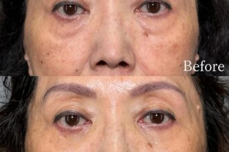 切らない目の下のクマ取り（経結膜脱脂術）