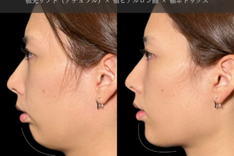 あご先リフト＋ ヒアルロン酸注射（顎）