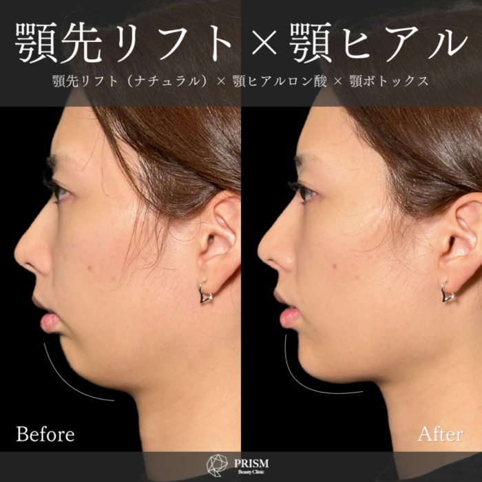 新宿・町田の美容外科・美容皮膚科｜PRISM Beauty Clinic 顔の脂肪吸引