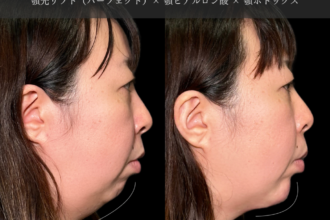 あご先リフト＋ ヒアルロン酸注射（顎）＋ボトックス注射（顎）