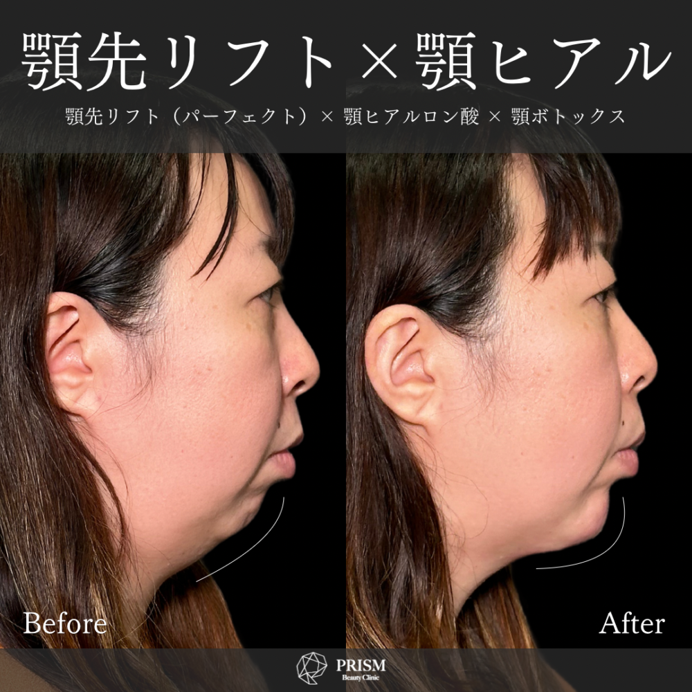 あご先リフト+ ヒアルロン酸注射(顎)+ボトックス注射(顎) あご先リフト+ ヒアルロン酸注射(顎)+ボトックス注射(顎)