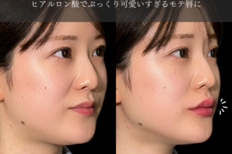 ヒアルロン酸注射(唇) ヒアルロン酸注射(唇)