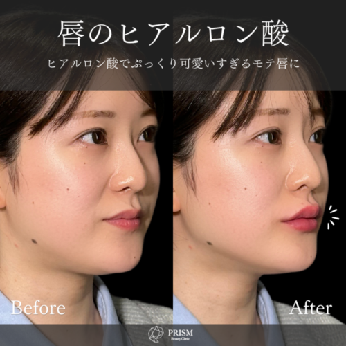 ヒアルロン酸注射（唇） - 新宿・町田の美容外科・美容皮膚科｜PRISM