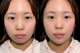 あご先リフト＋ ヒアルロン酸注射（顎）＋ボトックス注射（顎）