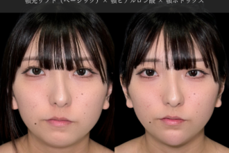 あご先リフト＋ ヒアルロン酸注射（顎）＋ボトックス注射（顎）