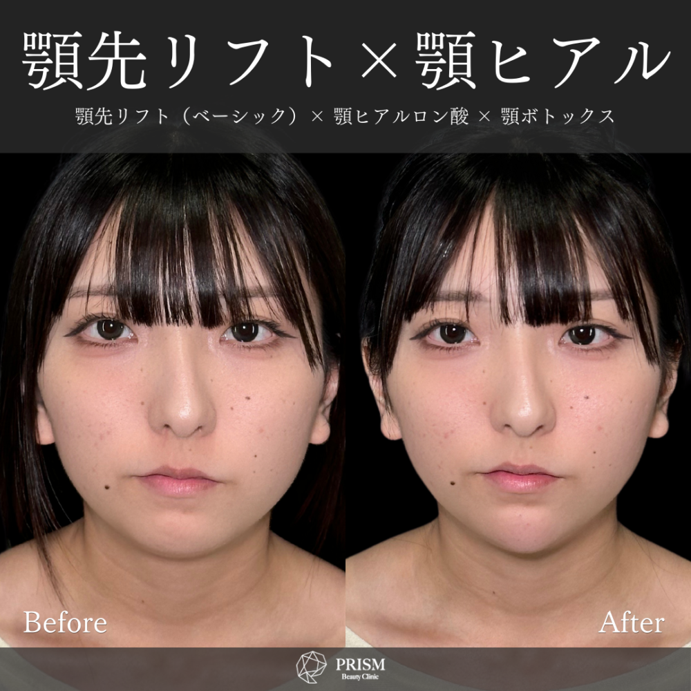 あご先リフト＋ ヒアルロン酸注射（顎）＋ボトックス注射（顎）