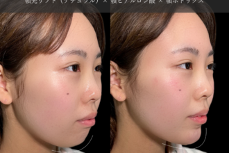 あご先リフト＋ ヒアルロン酸注射（顎）＋ボトックス注射（顎）