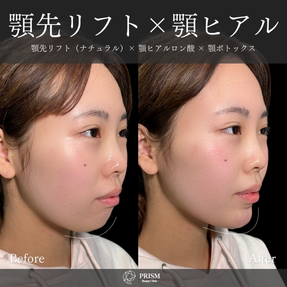 あご先リフト+ ヒアルロン酸注射(顎)+ボトックス注射(顎) あご先リフト+ ヒアルロン酸注射(顎)+ボトックス注射(顎)