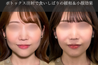 ボトックス注射（エラ）