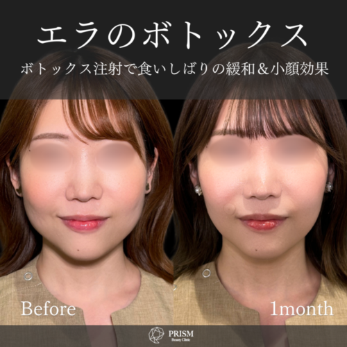 ボトックス注射（エラ） - 新宿・町田の美容外科・美容皮膚科｜PRISM