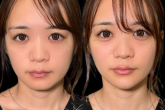 ヒアルロン酸注射（涙袋・顎）