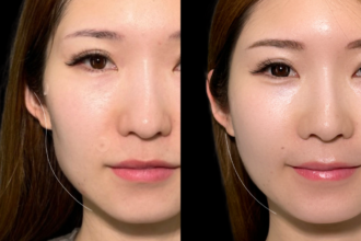 アルテミスリフト+ヒアルロン酸注射(頬・額・貴族) アルテミスリフト+ヒアルロン酸注射(頬・額・貴族)