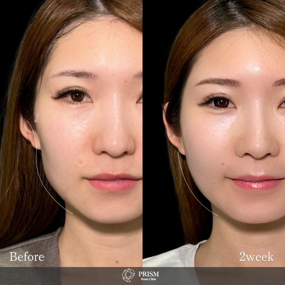 アルテミスリフト+ヒアルロン酸注射(頬・額・貴族) アルテミスリフト+ヒアルロン酸注射(頬・額・貴族)