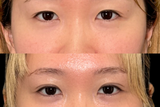 PRISM 1day二重埋没 ナチュラル 4点留め