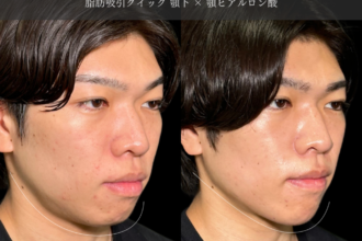脂肪吸引クイック(顎下)+ヒアルロン酸注射(顎) 脂肪吸引クイック(顎下)+ヒアルロン酸注射(顎)