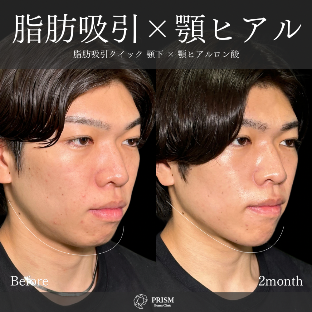 脂肪吸引クイック(顎下)+ヒアルロン酸注射(顎) 脂肪吸引クイック(顎下)+ヒアルロン酸注射(顎)