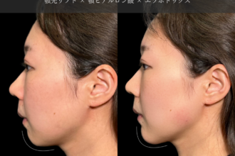 あご先リフト＋ボトックス（エラ）