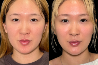 PRISM 1day二重埋没 ナチュラル 4点留め