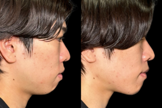 脂肪吸引クイック(顎下)+ヒアルロン酸注射(顎) 脂肪吸引クイック(顎下)+ヒアルロン酸注射(顎)