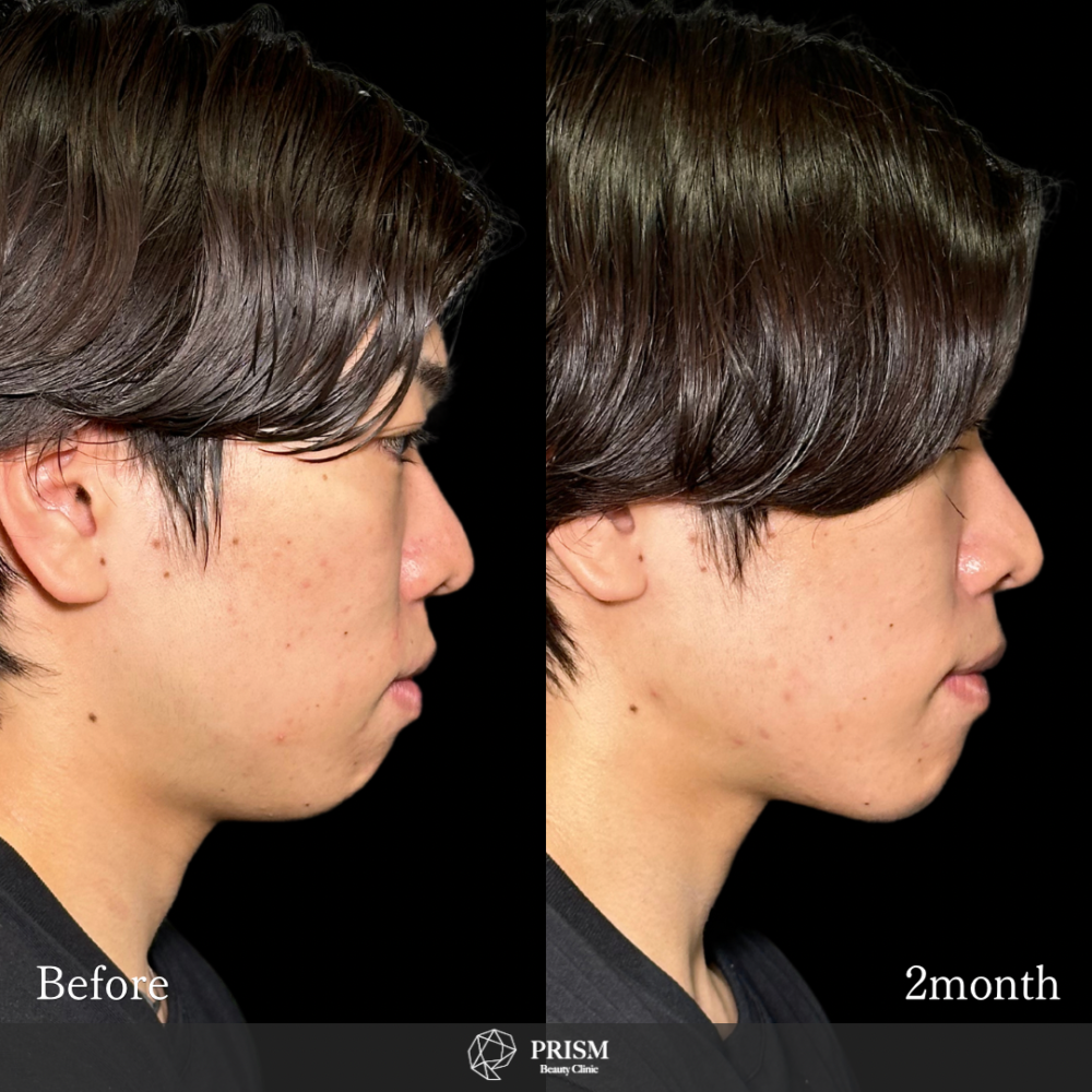 脂肪吸引クイック(顎下)+ヒアルロン酸注射(顎) 脂肪吸引クイック(顎下)+ヒアルロン酸注射(顎)