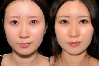 PRISM 1day二重埋没 ナチュラル 4点留め