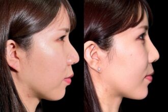 ヒアルロン酸(鼻、顎) ヒアルロン酸(鼻、顎)