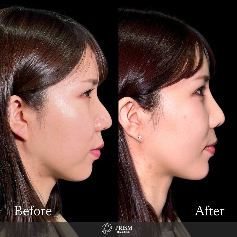 ヒアルロン酸（鼻、顎）