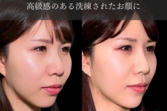 ヒアルロン酸(鼻、顎) ヒアルロン酸(鼻、顎)