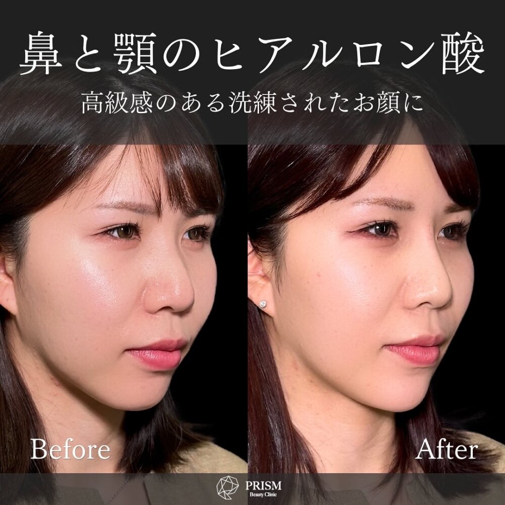 ヒアルロン酸（鼻、顎）