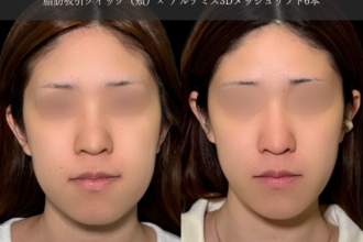 脂肪吸引クイック(頬)+糸リフト 脂肪吸引クイック(頬)+糸リフト