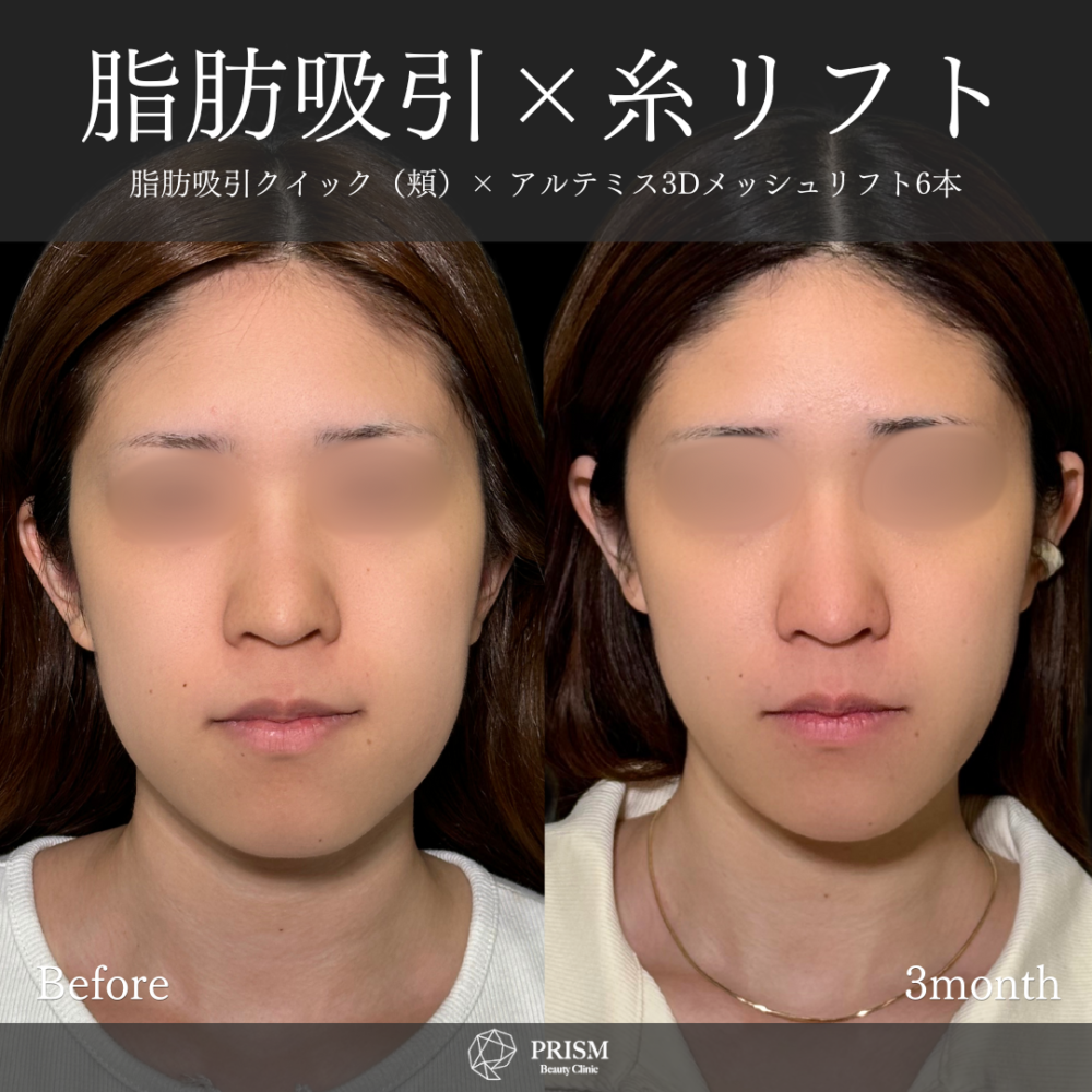 脂肪吸引クイック(頬)+糸リフト 脂肪吸引クイック(頬)+糸リフト