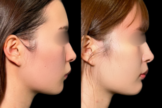 グランリフト+ヒアルロン酸注射(顎) グランリフト+ヒアルロン酸注射(顎)