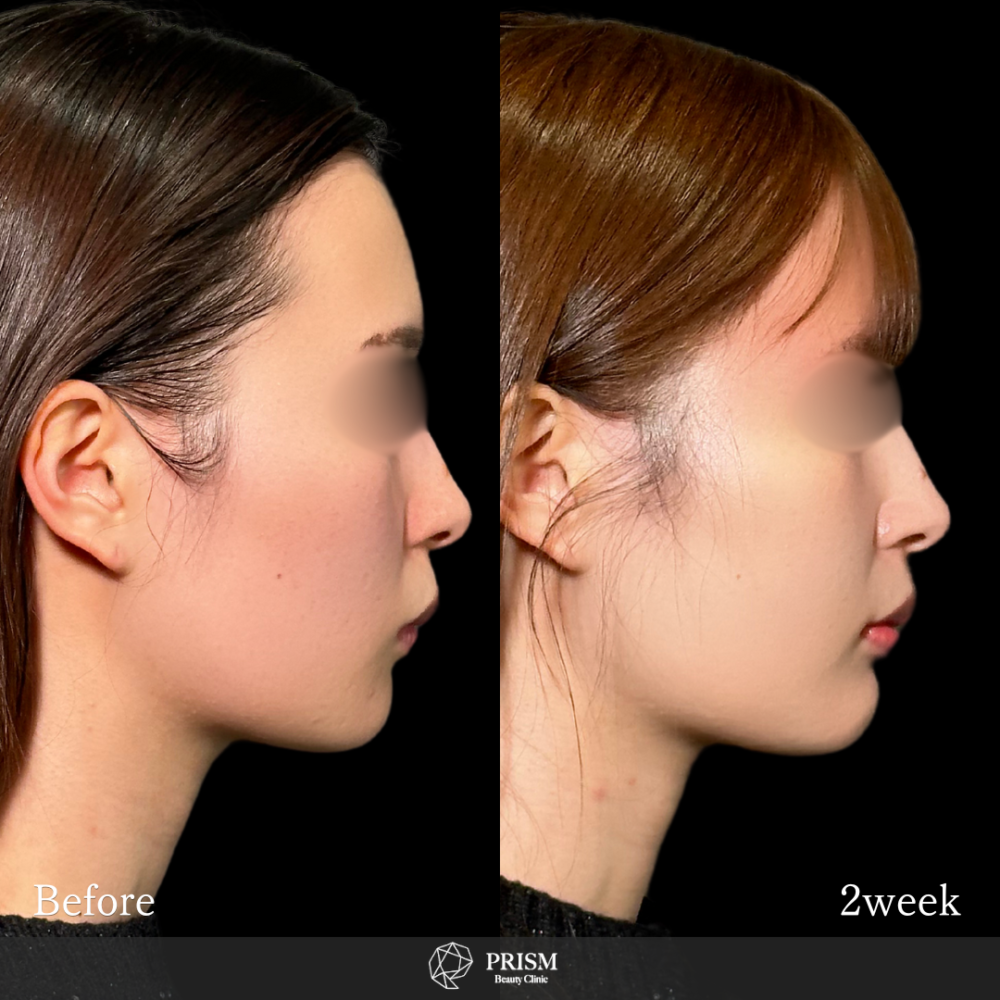 グランリフト+ヒアルロン酸注射(顎) グランリフト+ヒアルロン酸注射(顎)