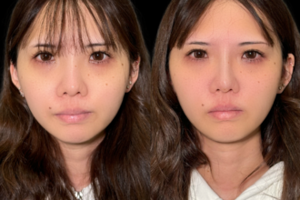 PRISMノーズスレッド