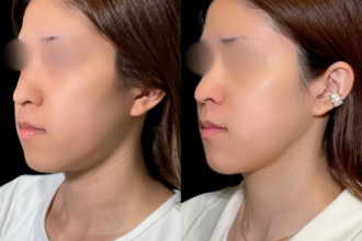 脂肪吸引クイック(頬)+糸リフト 脂肪吸引クイック(頬)+糸リフト