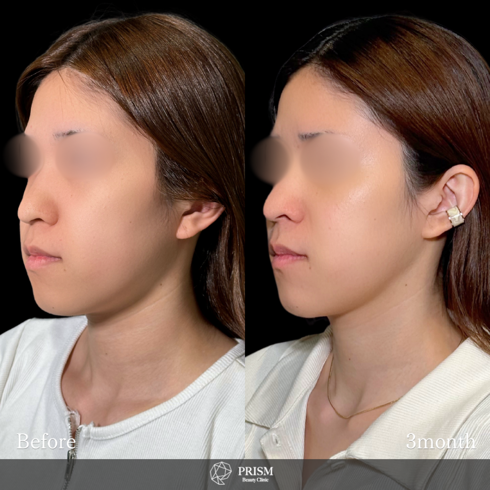 脂肪吸引クイック(頬)+糸リフト 脂肪吸引クイック(頬)+糸リフト