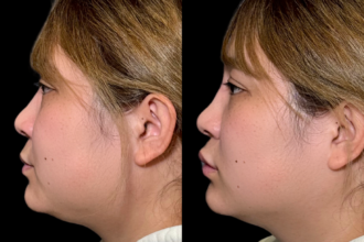 ヒアルロン酸注射(鼻・唇) ヒアルロン酸注射(鼻・唇)