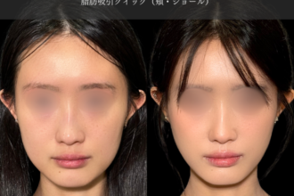 脂肪吸引クイック(頬) 脂肪吸引クイック(頬)