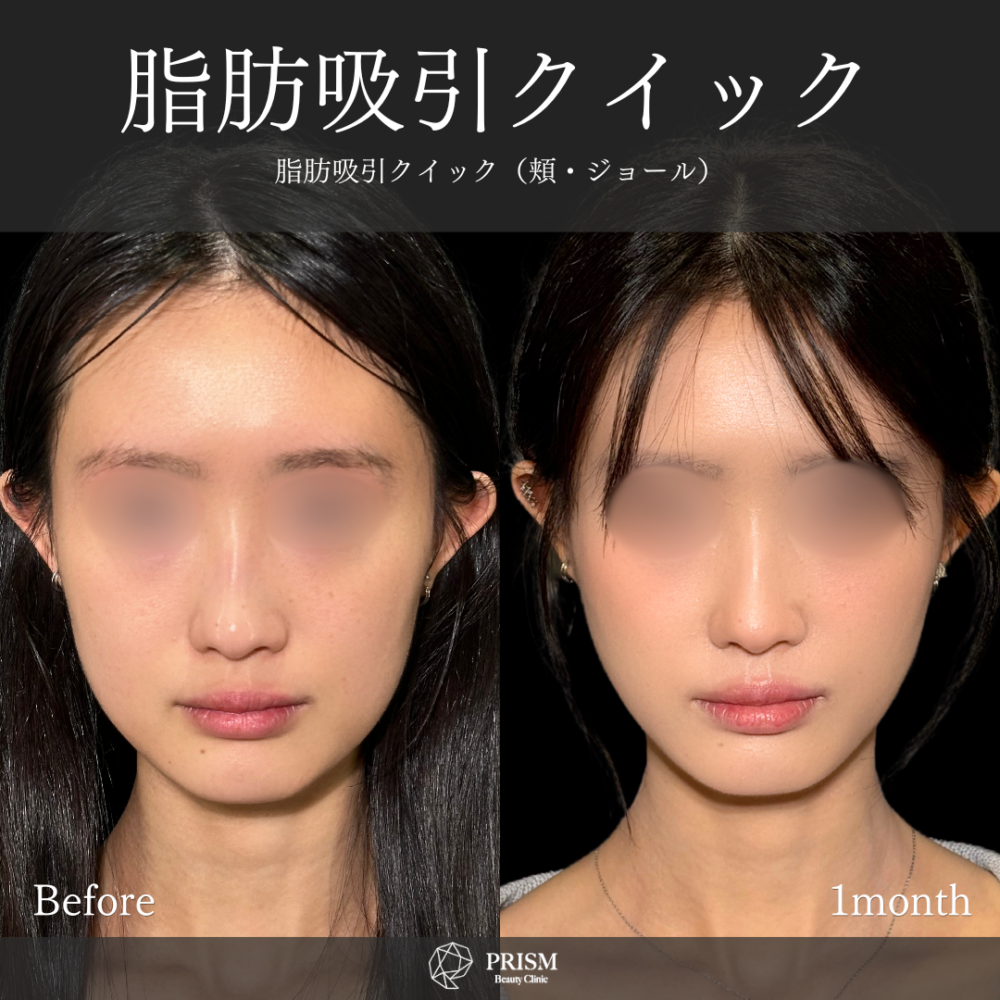 症例写真 < 新宿・町田の美容外科・美容皮膚科｜PRISM Beauty Clinic